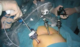 腹腔镜手术视频,高清视频解析